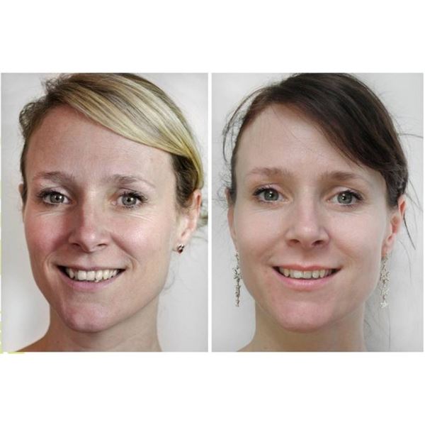 Dermaroller 540 nålar med titannålar 0,5 mm för ansiktet - | Fashiongirl