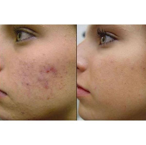 Dermaroller 540 nålar med titannålar 0,5 mm för ansiktet - | Fashiongirl