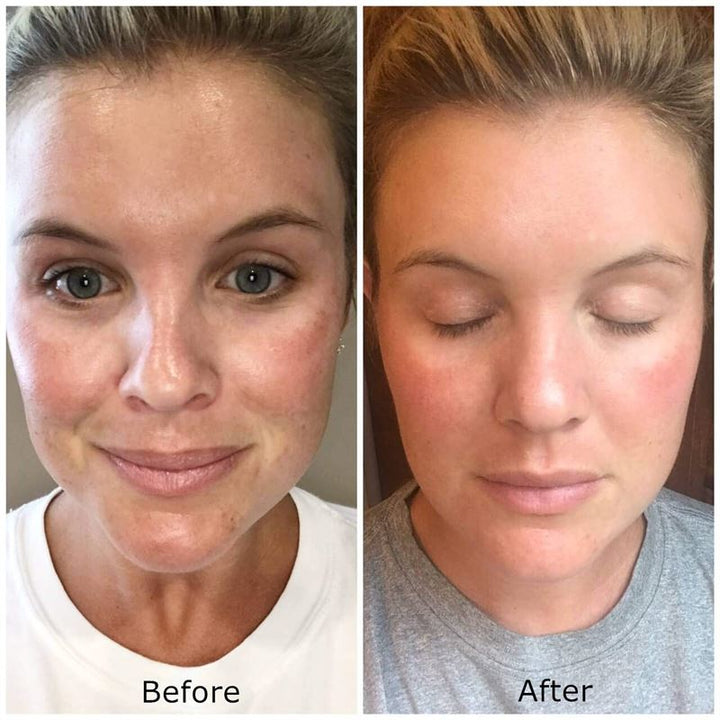 Dermaroller 540 nålar med titannålar 0,5 mm för ansiktet - | Fashiongirl