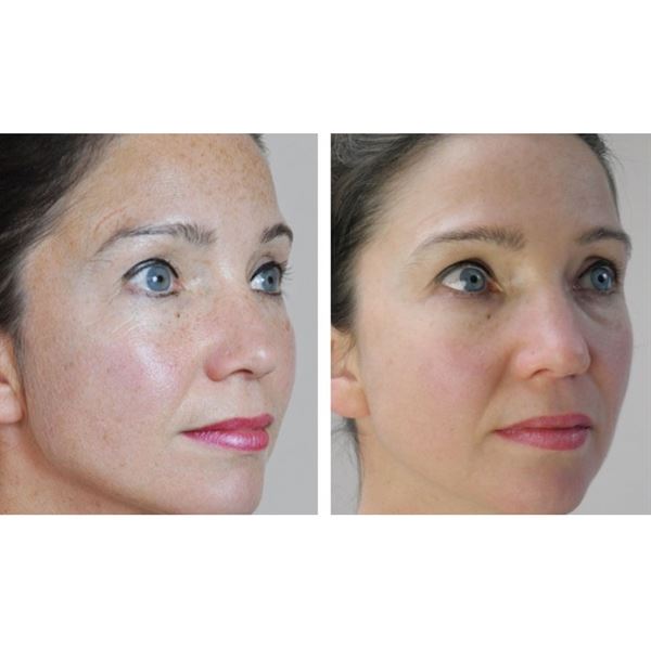 Dermaroller 540 nålar med titannålar 0,5 mm för ansiktet - | Fashiongirl