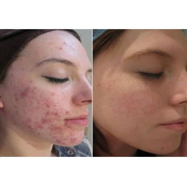 Dermaroller 540 nålar med titannålar 0,5 mm för ansiktet - | Fashiongirl